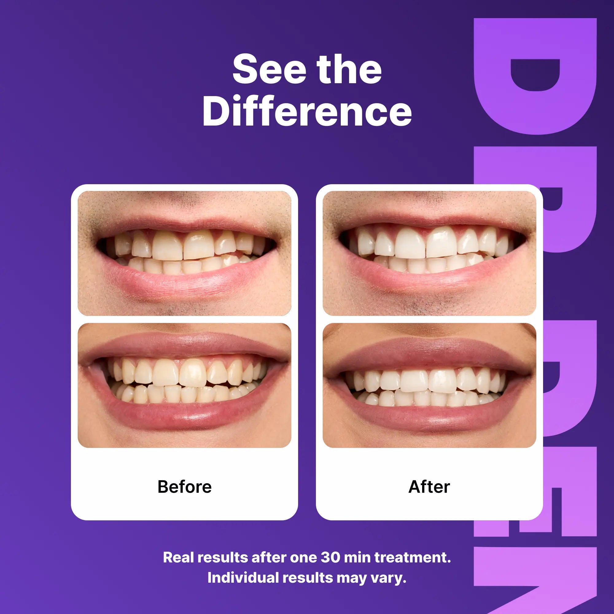 Achieve a Dazzling Smile with DRDENT Purple Teeth Whitening Strips - 7/21 Sessions of Enamel-Safe, Non-Sensitive Whitening - Peroxide-Free Formula